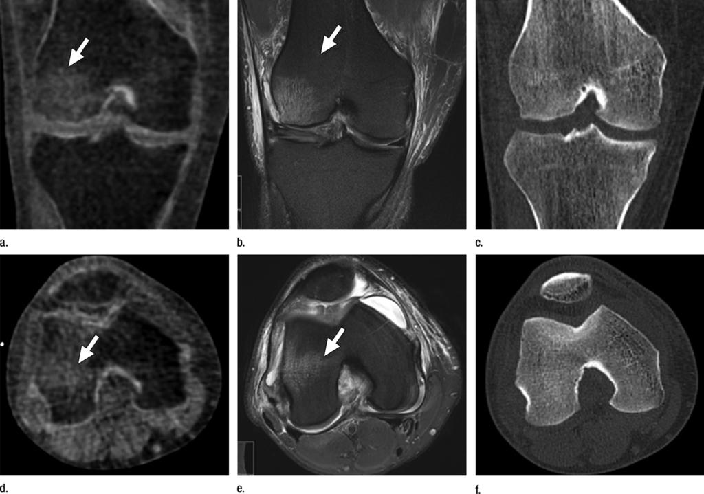 Figure 14 Figure 14: Dual-energy CT virtual noncalcium images acquired 11 days after injury demonstrate bone bruises in the lateral femoral condyle of a 29-year-old male soccer player.