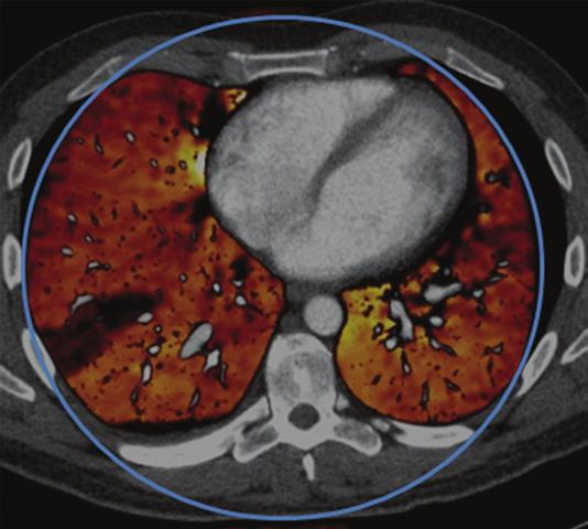 The dark regions show a perfusion defect secondary to the embolism. Blue circle marks the diameter of the second tube on the dual-source CT scanner.