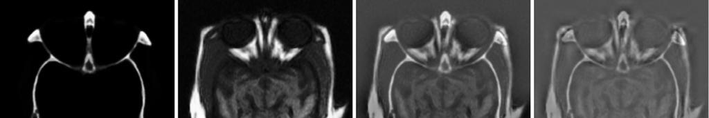 Fig. : Medical images: (a) CT image, (b) MRI image, (c) Fused by Laplacian pyramid, (d) Fused by