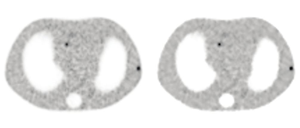 adjacent hot organ. (b) Reconstructed images from a 40M count study acquired on a Discovery PET/CT 710.