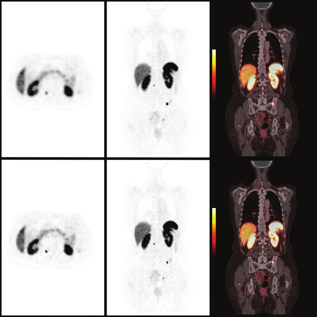 4 g/ml (b) 2 iter 25 iter SUV mean: 10.9 g/ml Figure 6. (a) NEMA Image Quality Phantom (Data Spectrum, Durham, NC) images from a study acquired on a Discovery PET/CT 710.