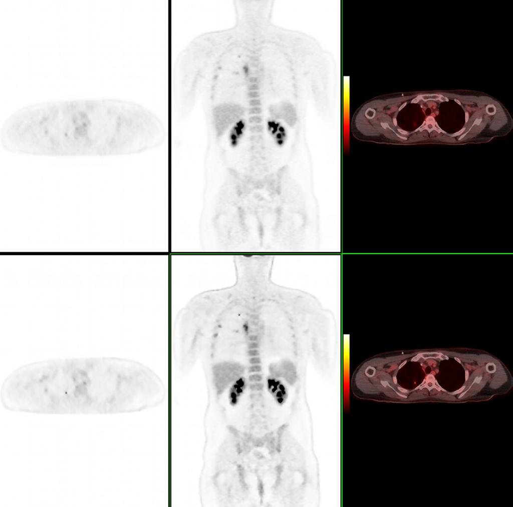 Figure 9 shows 18 F-FDG clinical images acquired on the Discovery PET/CT 600 which also demonstrates a significant increase in SUV mean with.
