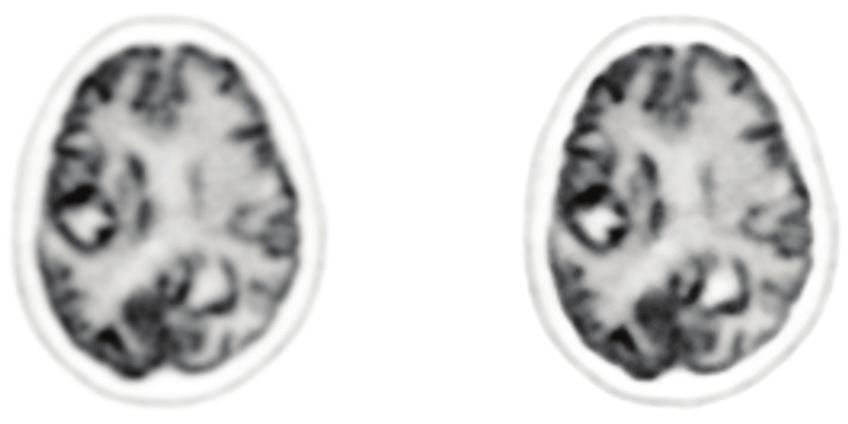 The image was reconstructed with a β=200 and no post filtering. Figure 10 shows 18 F-FDG brain images from two exams acquired on a Discovery PET/CT 690 and reconstructed with and.