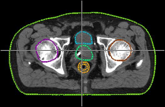Example CT images from a hip prosthesis free male patient with key anatomical structures outlined by the radiation oncologist: axial (a) and coronal (b) views, respectively.