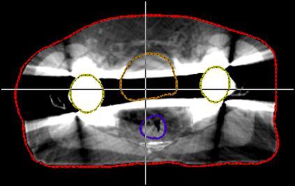 2. BACKGROUND 20 When both hips contain metallic prostheses, artifact levels in the CT images are even more elevated (Figure 2.15)