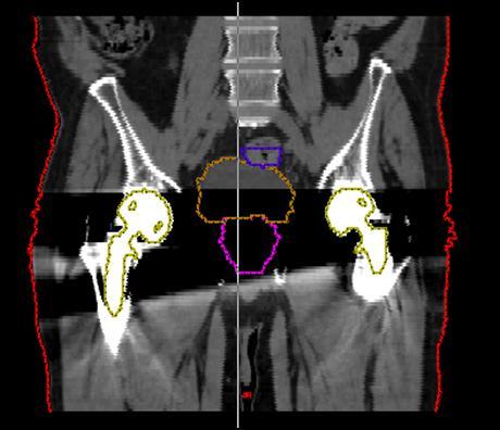 Example CT images from a male patient with two metallic hip implants and with key anatomical structures outlined by the radiation oncologist: axial (a) and coronal (b) views, respectively.