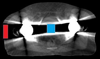 3. MATERIALS AND METHODS 35 3.3. CFMAR performance analysis The performance of the presented MAR algorithm was assessed both qualitatively and quantitatively on both one and two metallic hip implant cases.