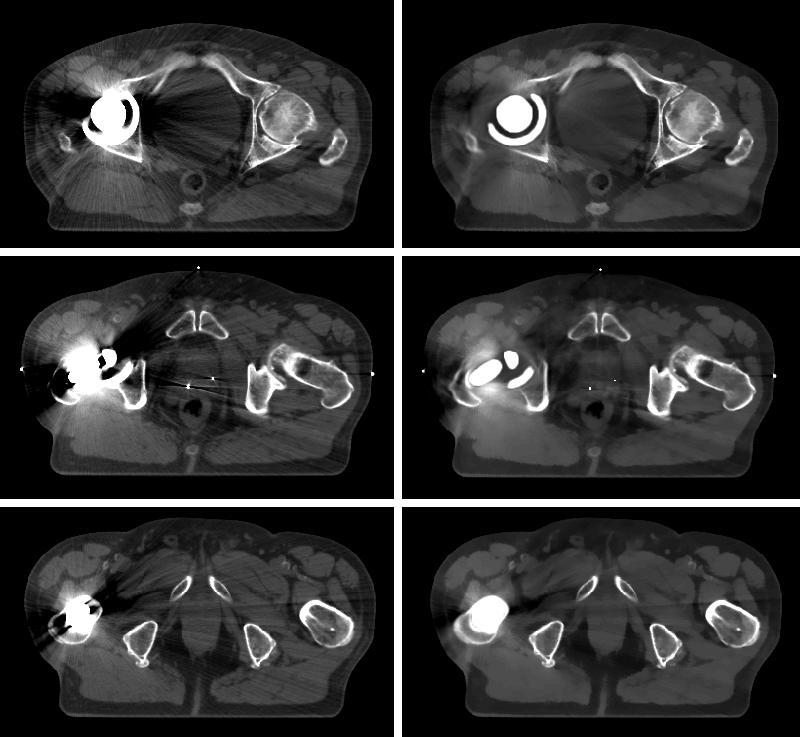 4. RESULTS 37 4.1. Qualitative Evaluation In the current chapter axial slice images and a coronal slice image from both datasets are presented before and after the application of CFMAR algorithm.