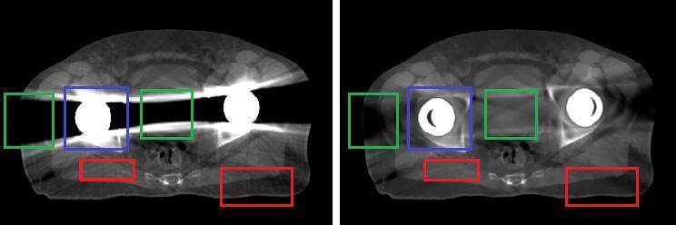 (Figures 4.5-4.6). (a) (b) Figure 4.5. Uncorrected (a) and corrected (b) axial CT slice images from the single hip implant pelvic scan with the outlined sub-image locations.