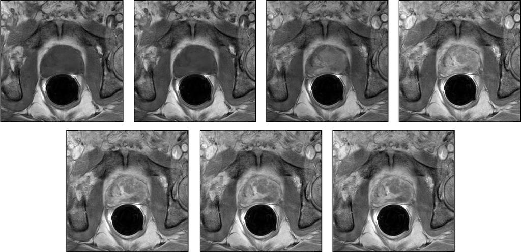 Figure 2 - DCE-MRI Sequence, the upper left corner is a slice of MRI before injecting the contrast, the following images are acquired after injecting the contrast agent.