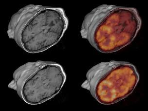 Minneapolis Veterans Affairs Medical Center Three-dimensional data visualization of MRI and PET datasets for two