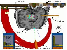 Image Registration: Motivation Brain Bench: Virtual tools for stereotactic frame surgery Luis Serra, Wieslaw L.