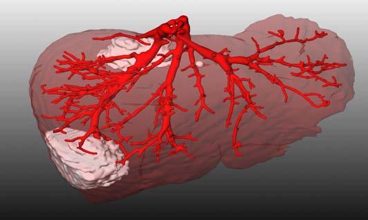 Application Scenarios Tumor Resection (1) Visualization of the portal vein inside a human liver (with three tumors).