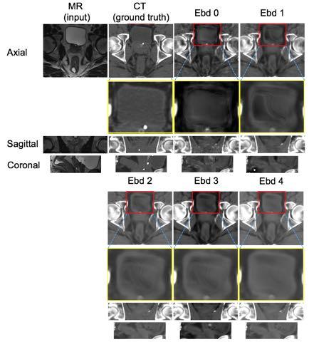 Fig. 5. The brain CT images synthesized using our DECNN model with different numbers of embedding blocks, i.e., 0 (middle), 1 (last second column), and 2 (last column). Fig. 6.