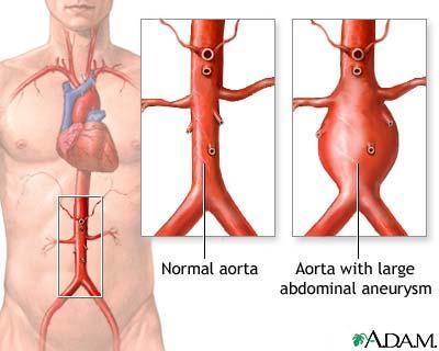 4. Medical Background Figure 4.1.: Aorta with abdominal aortic aneurysm (AAA). 4.1.2. AAA Facts There are about 1.5 million patients suffering from AAA in the U.S.