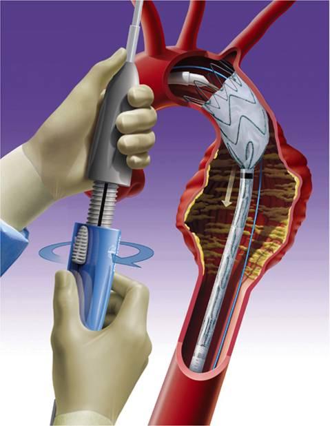4.2. Endovascular Aneurysm Repair (EVAR) Aneurysm Stent graft (unfolding) Stent graft (folded) Delivery catheter Iliac arteries (a) EVAR: Release of the stent graft.