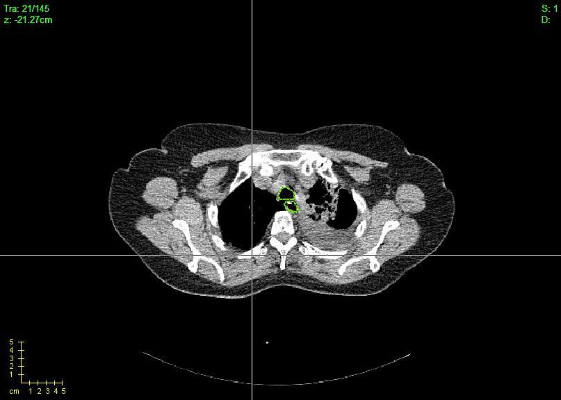 Figure 3.2 Visualization of marked phase using CERR (area inside the green boundary is an airway) 3.