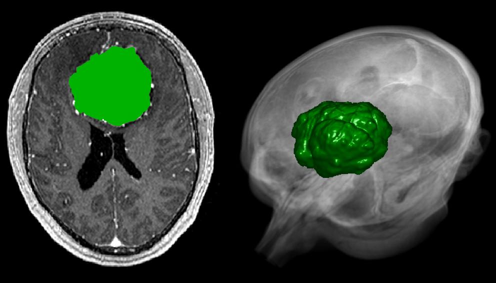 Validation: Meningiomas (brain tumor) Diameters Manual