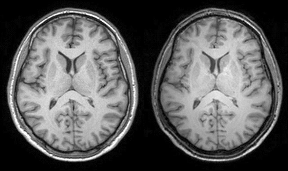 Non-rigid image registration Figure 6. An example of 1.5 T versus 3 T MRI of the brain. It must be remembered that image acquisition is evolving along with image registration.