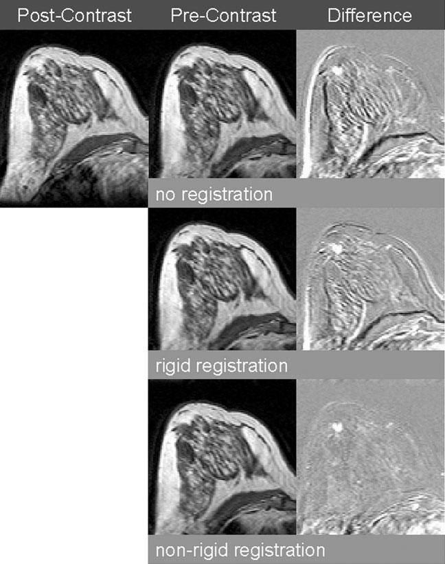 Non-rigid image registration correct for differences in positioning and scanning protocol between pre-operative 1.5 T MR images and 0.5 T MR images acquired during brachytherapy sessions [93].