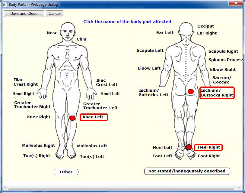 To select the locations of the Pressure Ulcers click on the
