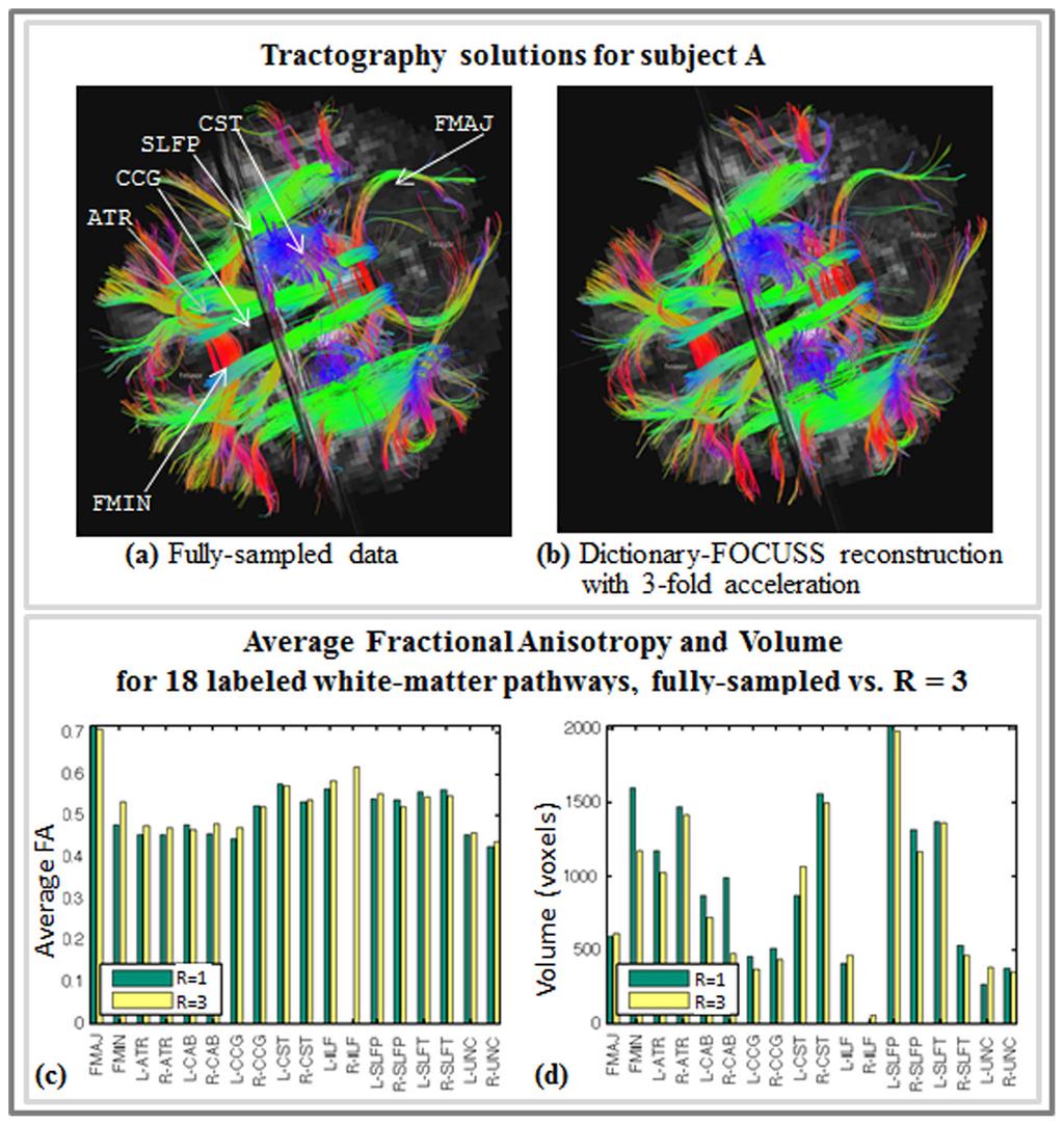 Bilgic et al. Page 16 Fig. 7. Axial view of white-matter pathways labeled from streamline DSI tractography in fullysampled data (a) and Dictionary-FOCUSS reconstruction at R = 3 (b).