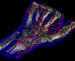 ACM SIGGRAPH 2004 179 Figure 34.1: Segmented hand data set (256x128x256) with three objects: skin, blood vessels, and bone.