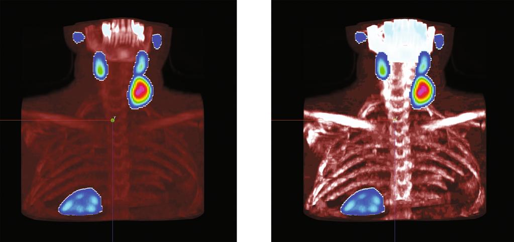 CT SPECT Analyzer - A Tool for CT and SPECT 17 Fig. 4. Raw (left) and HU corrected (right) volume examples Fig. 5.