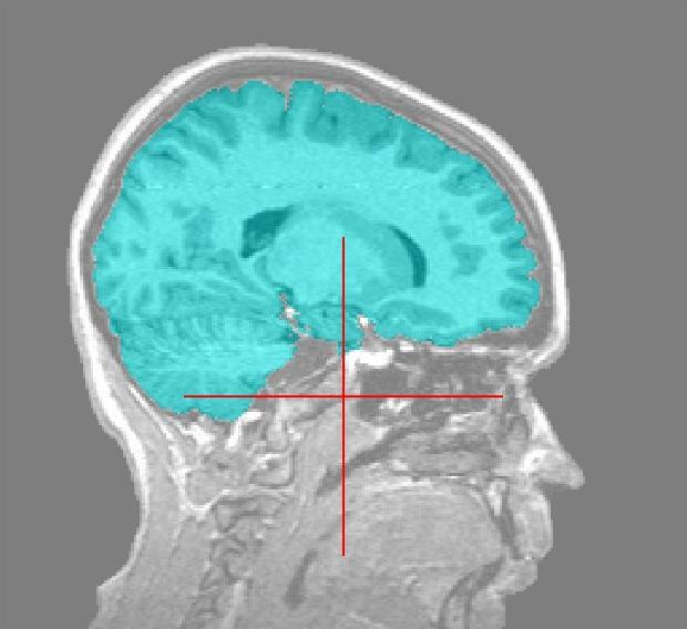 Figure 4: Good Segmentation of the Brain Figure 5: Bad Segmentation of the Brain the heads in the images has to be standardized.
