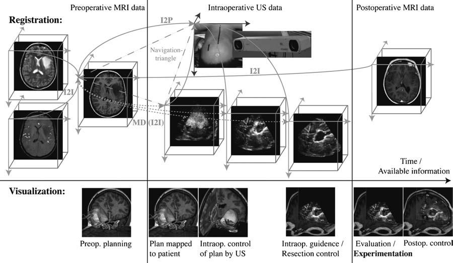 52 Lindseth et al.: Image Fusion in US-Based Neuronavigation Fig. 2. Registration of preoperative images to each other (I2I reg.