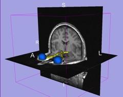 Tutorial Dataset The Slicer3minute dataset is composed of an MR scan of the brain and 3D surface reconstructions of anatomical structures.