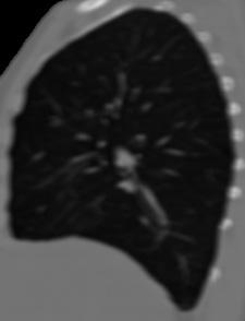 projection of the original and GSS filtered CT