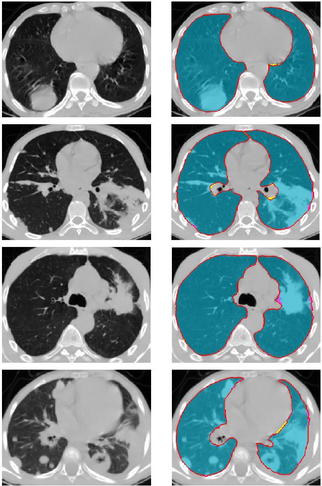 FIGURE 24: Other 4 subjects from the UoLDB: original CT chest images with different pathologies: (left: from top to bottom) lung mass; consolidation; lung cancer, and cavitation + consolidation