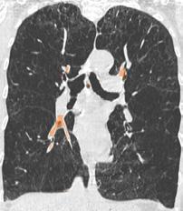 [10] Subject #37 Error Segmented lungs Subject #25 Error