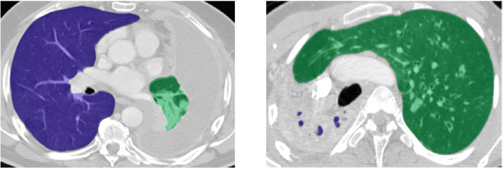 FIGURE 31: Impacts of severe right and left lung pathologies on the proposed segmentation accuracy: the ground-truth-to-left-lung overlaps of 87.4% (left) and 5.