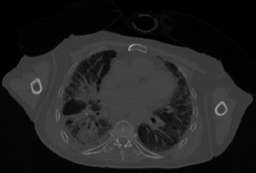 Relying on only the CT appearance, i.e., Hounsfield units (HU), leads to a late RILI detection that will make the treatment more difficult.