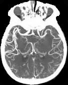 FIGURE 4: Brain CTA image.