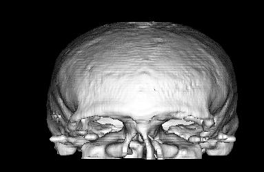 In Figure 2 the segmented head images are presented: The skull is segmented from PD images The raw image of the cortex is obtained