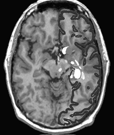 Image Segmentation 13 Figure 6: Three slices from a MR brain volume overlaid with a warped atlas (Images provided courtesy of C.A. Davatzikos).