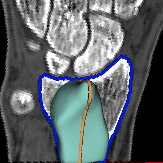 The first row shows the radius bone in a CT image.