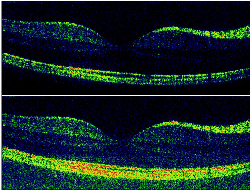 Figure 5. Results for in vivo tomogram (fovea centralis of a healthy human). Filter bank (lower image) gives a SNR increase of 6 db compared to the conventional approach based on FFT (upper image).