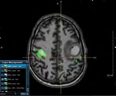 A better way for YOU and YOUR patient brought to you by Advanced Neuro analysis with access to studies wherever you need it Advanced Neuro from Invivo Advancements in MRI technology and analysis are