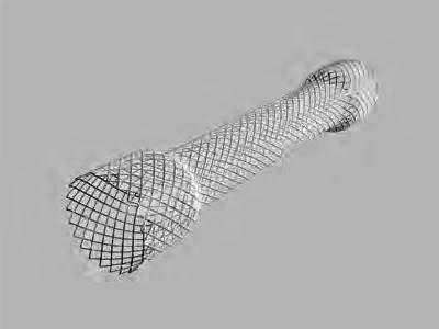 Esophageal/Gastric/Colonic - Metal Stents Evolution Esophageal Controlled-Release Stent - Fully Covered Used to maintain patency of malignant esophageal strictures and/ or to seal tracheoesophageal