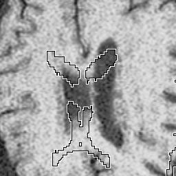 Figure 16 is a close-up on the registration of the lateral ventricles along the deformation hierarchy. The improvement of alignment accuracy is significant.