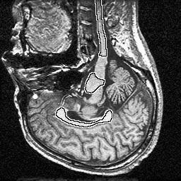 The atlas exhibits an approximate symmetry about the central line, whereas the symmetry is destroyed in the patient s data due to the existence of the pathology.