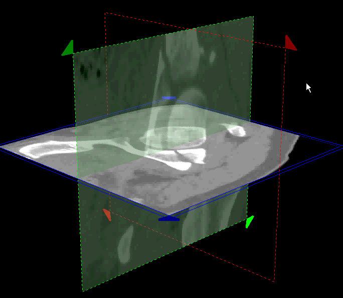 Optimal boundary in 3D 3D bone