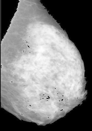 Fig 3: Pectoral Region removed mammogram