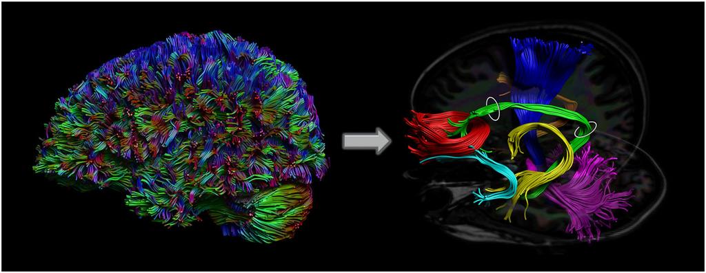 JEURISSEN ET AL. 7 of 22 3.5 Track termination and acceptance criteria A final aspect of streamline tractography is choosing when to stop the tracking process.