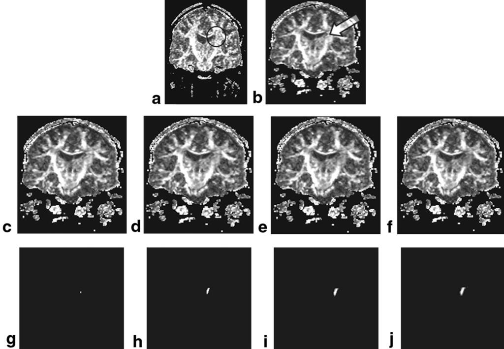 180 Xu et al. FIG. 7. Result of the second experiment. a: A typical slice of the FA volume of the normal brain before warping.