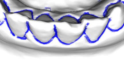 5 Edge Tangent Flow In dgtzed dental casts, often nterstces between adjacent teeth vansh due to severe maloccluson or low resoluton scanners.